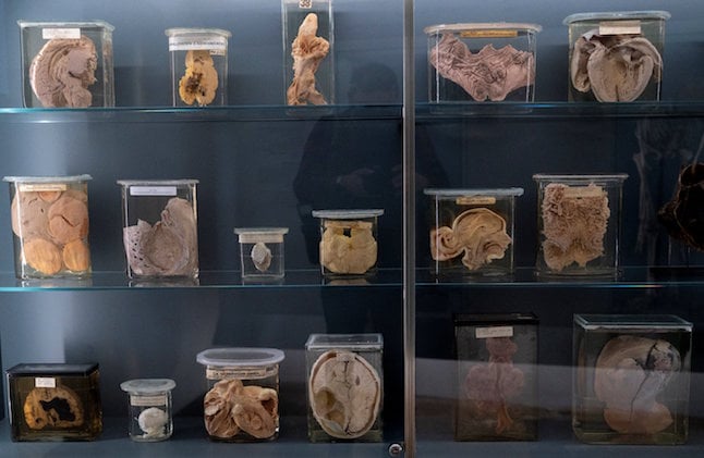 Vienna exhibition tests ethics of displaying human remains